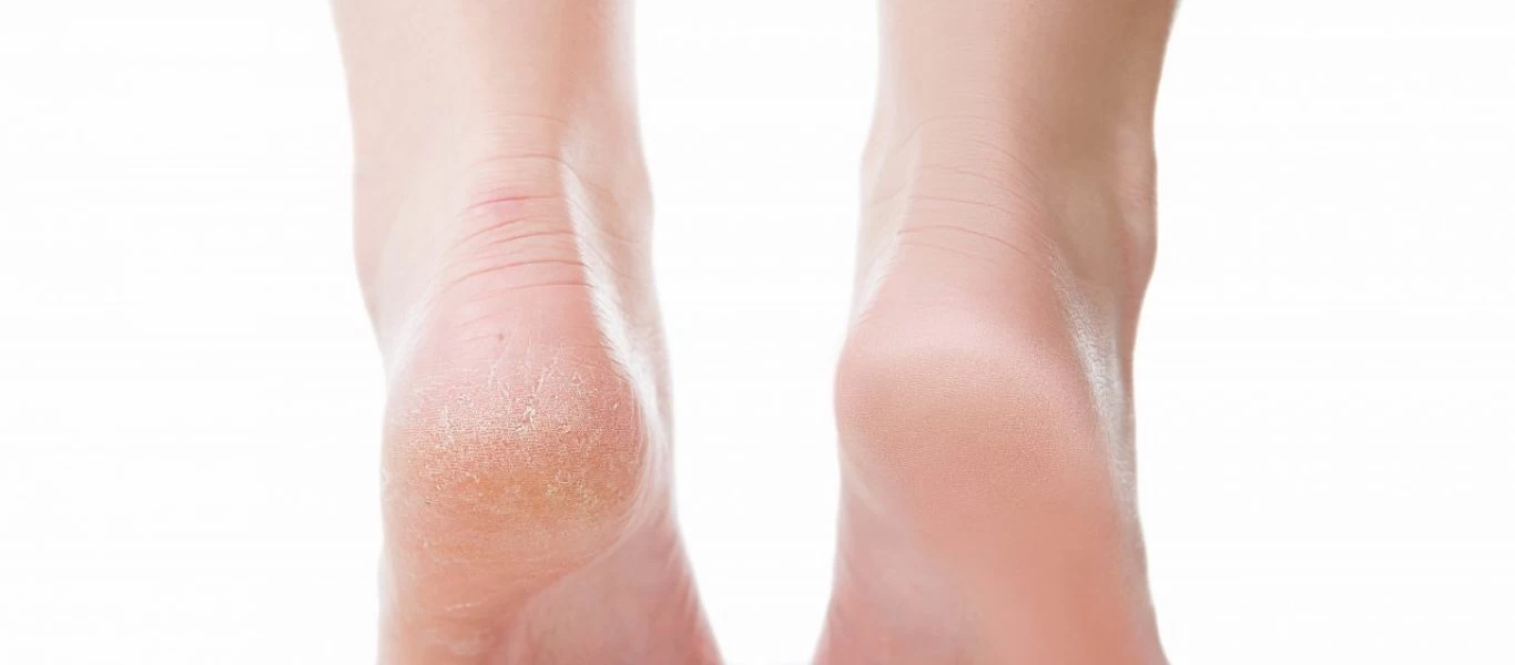 Τι μπορεί να φταίει για τις σκασμένες φτέρνες το καλοκαίρι;